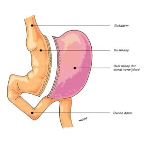 Foodblogger gaat aan de maagverkleining